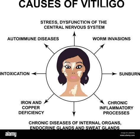 Causes Of Vitiligo World Vitiligo Day Infographics Vector