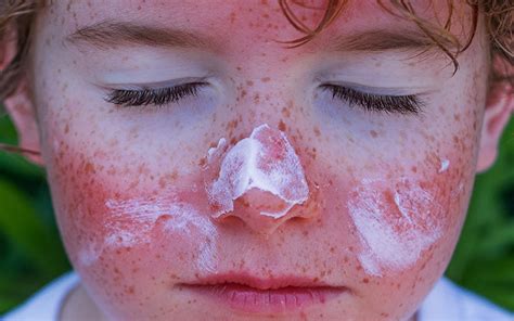 Sunburn On Face Causes Symptoms Treatments And Preventive Tips Vedix