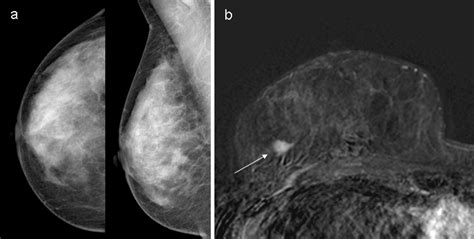 Breast Mri Of Pure Ductal Carcinoma In Situ Sensitivity Of Diagnosis