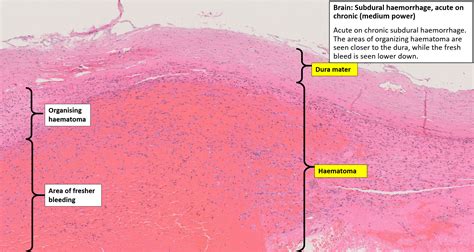 Brain Old Subdural Haematoma Nus Pathweb Nus Pathweb