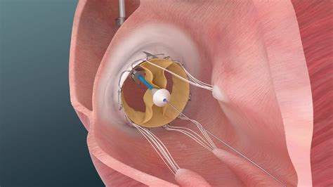 Trisol Begins Early Feasibility Study Of Transcatheter Tricuspid Valve