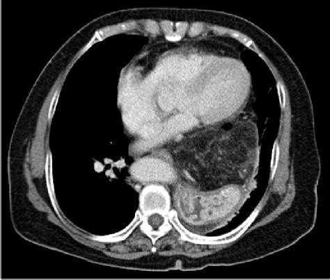 A Contrast Enhanced Ct Scan Shows A Wide Defect Of The Esophageal