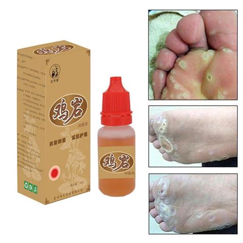 Effective Body Warts Treatment Cream Foot Corn Removal Patch Plantar