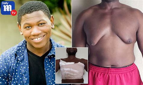 man gets moob job to reduce the size of overgrown breasts after 17 years daily mail online