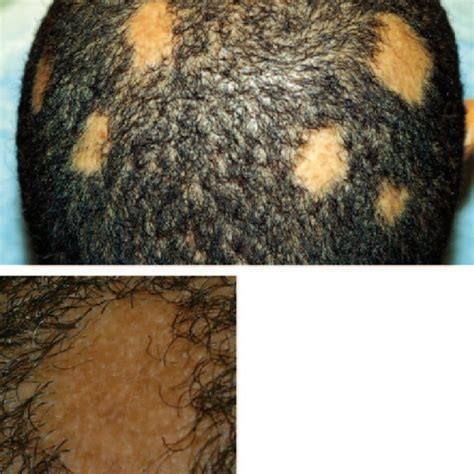 11 Tinea Versicolor Showing Hyperpigmented Lesions Upper Photos And