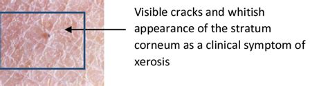 Visible Signs Of Xerosis Cutis 24 Download Scientific Diagram
