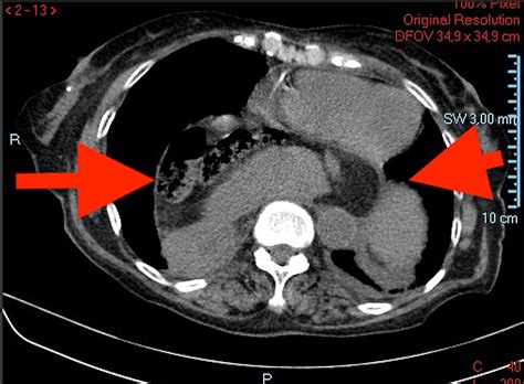 Cureus Gastric Volvulus A Multidisciplinary Approach And