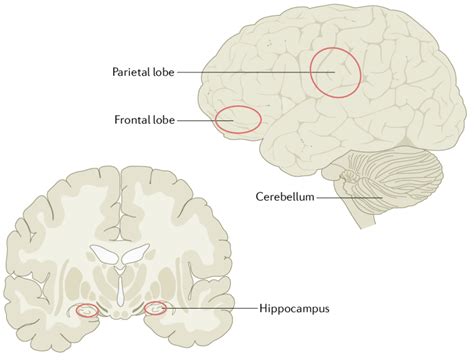 Neuroimaging Findings In Alzheimer Disease Psychosis Neuroimaging