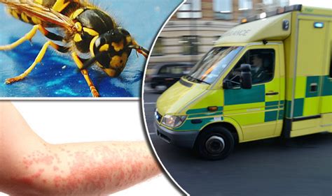 Anaphylaxis Alert Allergy Warning As Risk Of Wasp Stings Increase In