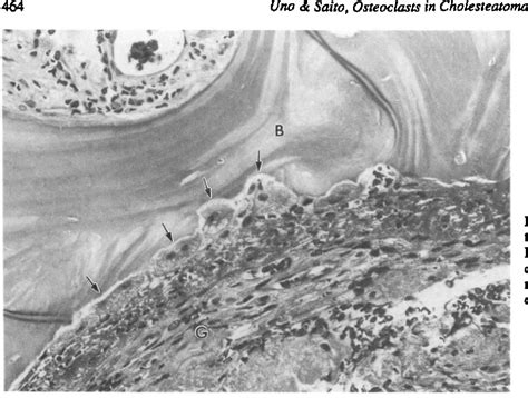 Figure 1 From Bone Resorption In Human Cholesteatoma Morphological
