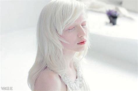 On Twitter Nastya Zhidkova Albino Girl Nastya