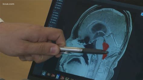 Central Texas Doctors Remove Tapeworm From Mans Brain After He Complained Of Headaches