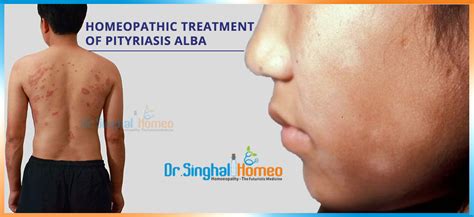 Pityriasis alba is a skin condition that commonly happens to children and to young adults, but any person can acquire it as well. Homeopathic Treatment of Pityriasis Alba | Dr. Singhal Homeo
