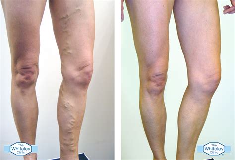 Varicose Veins Everything You Need To Know My Weekly