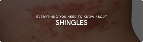 Shingles Causes Treatments And Natural Remedies