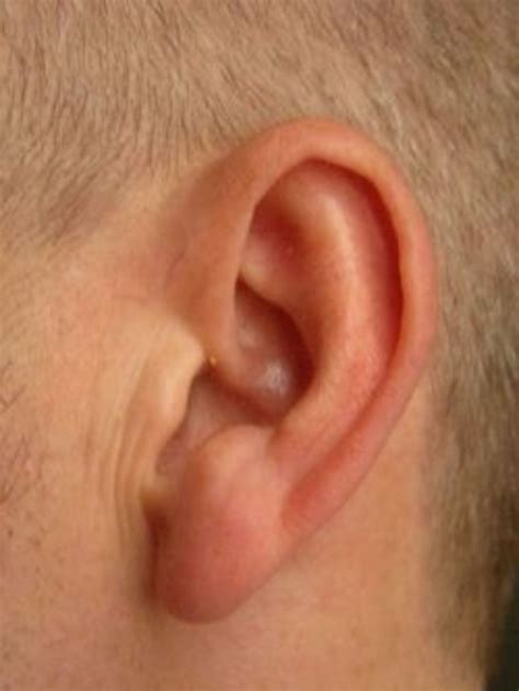Ear Abscess Everything You Need To Know Healdove