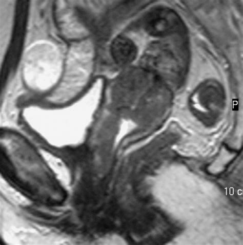 Mr Imaging Of The Uterine Cervix Imaging Pathologic Correlation Radiographics