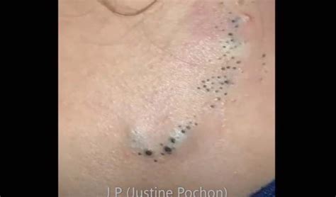 Lots Of Pimple And Blackheads On Neck Link In Comments Rpopping