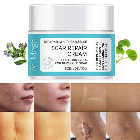 Buy Scar Removal Cream Scar Cream For Old Scars Stretch Mark Removal Cream For Men And Women