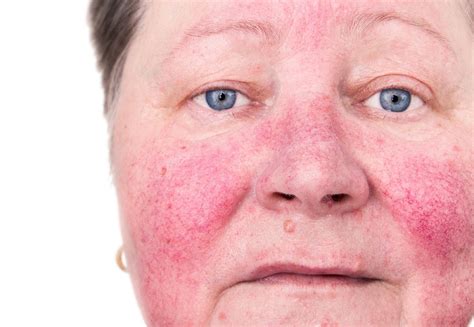 Rosacea Rash On Face