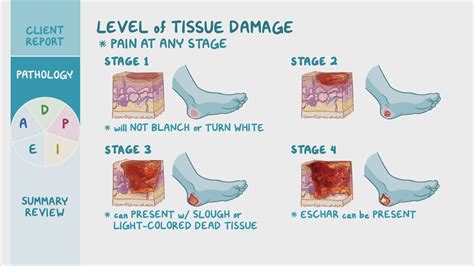 Pressure Injury Stages Pressure Ulcer Staging Interna
