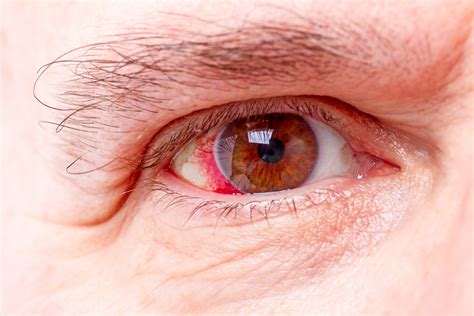 Minor Eye Condition Services Mecs Goldwyn Opticians And Sydney