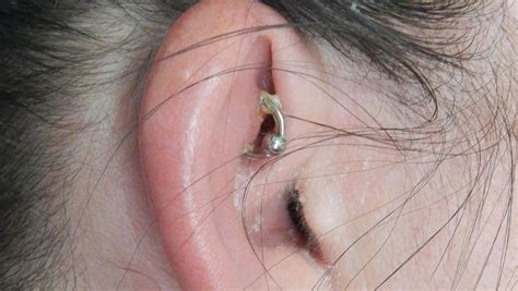 What Does An Infected Ear Piercing Look Like Ent And Allergy Associates Atelier Yuwa Ciao Jp