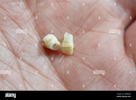 Tooth Decay And Baby Hi Res Stock Photography And Images Alamy