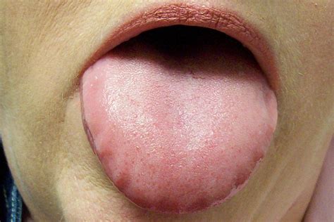 Your Tongue Could Be The Window To Your Health Dr Thind