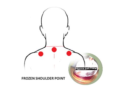 Frozen Shoulder Back Points Cupping Therapy Hijama Acupressure Points