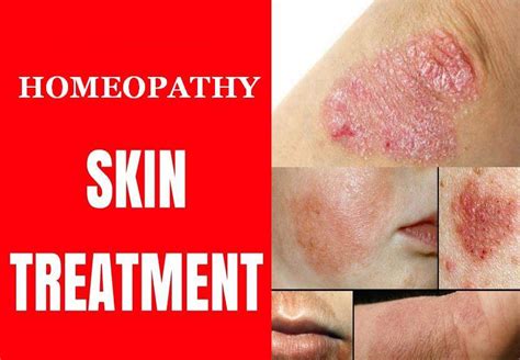 Fungal Skin Infections Treatment Of Fungal Skin Infections Types My