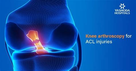 Anterior Cruciate Ligament Tearacl Injuries Symptoms Diagnosis And