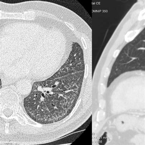 Ct Of The Lungs At The Level Of Carina And Right Inferior Pulmonary