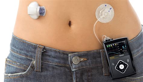 Diabetes Insulin Pump How Insulin Pump Work Pros Cons