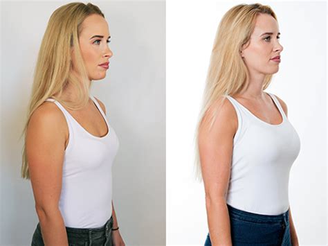 Augmented Mastopexy Surgery Boob Lift UK Breast Uplift And Enlargement