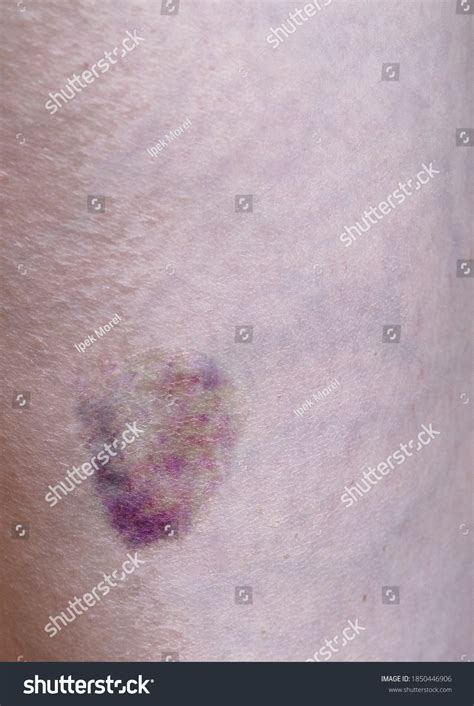 Bruise On Womans Body Subcutaneous Injury Foto Stock 1850446906