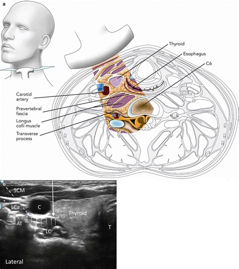 Stellate Ganglion Section Evidence Of Cardiovascular Vrogue Co