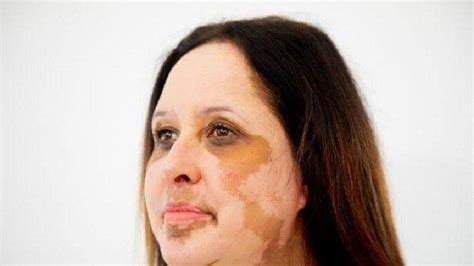 Atasi Vitiligo Dengan Pengobatan Ini Simak Anjuran Dr Arini Widodo