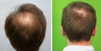 It also reveals two basic head shapes: Crown Hair Restoration - DermHair Clinic Los Angeles 1-310 ...