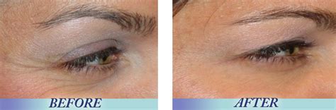 No haircut cream before and after. PURE RETINOL VITAMIN A 2.5% Anti Aging Wrinkle Acne Serum ...
