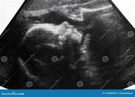 Ultrasound 3d Photo Of Unborn Baby In Mother S Womb Ultrasonographer