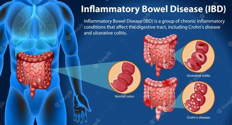 Free Vector Inflammatory Bowel Disease Ibd Infographic