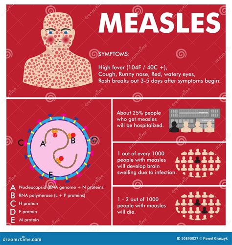 Vector Measles Infographic Stock Vector Illustration Of Patient 50890827