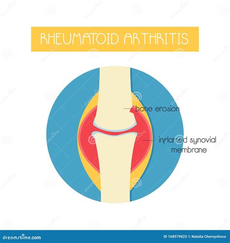 Illustration Of A Bone With Rheumatoid Arthritis Stock Vector