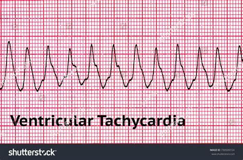 Ventricular Tachycardia Causes Symptoms And Treatment 46 Off