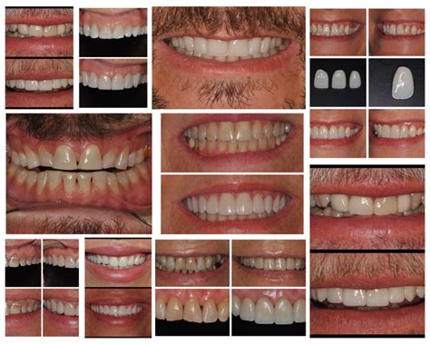 Porcelain Veneer Smile Makeover Are You Ready To Enhance Your Smile