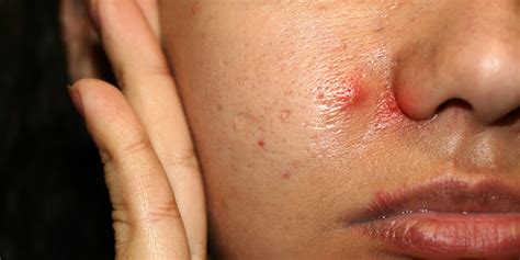 Acne Keloidalis Nuchae Akn Causes Symptoms Treatments And Tips