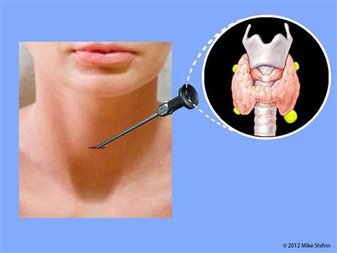 Primary Hyperparathyroidism And Minimally Invasive Parathyroid Surgery