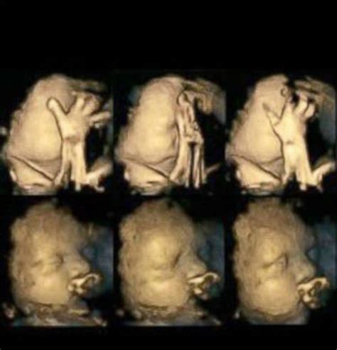 photos what fetuses with smoker moms look like abc7 san francisco