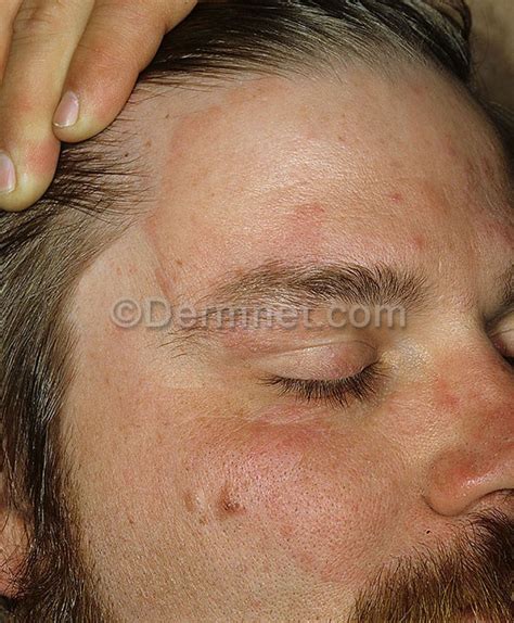 Tinea Ringworm Face Photo Skin Disease Pictures